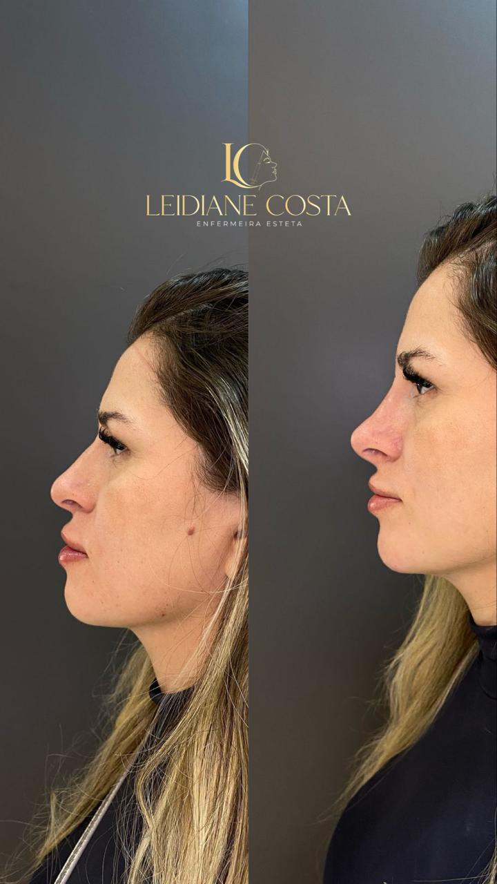 Antes e depois - Rinomodelação - Dra. Leidiane Costa